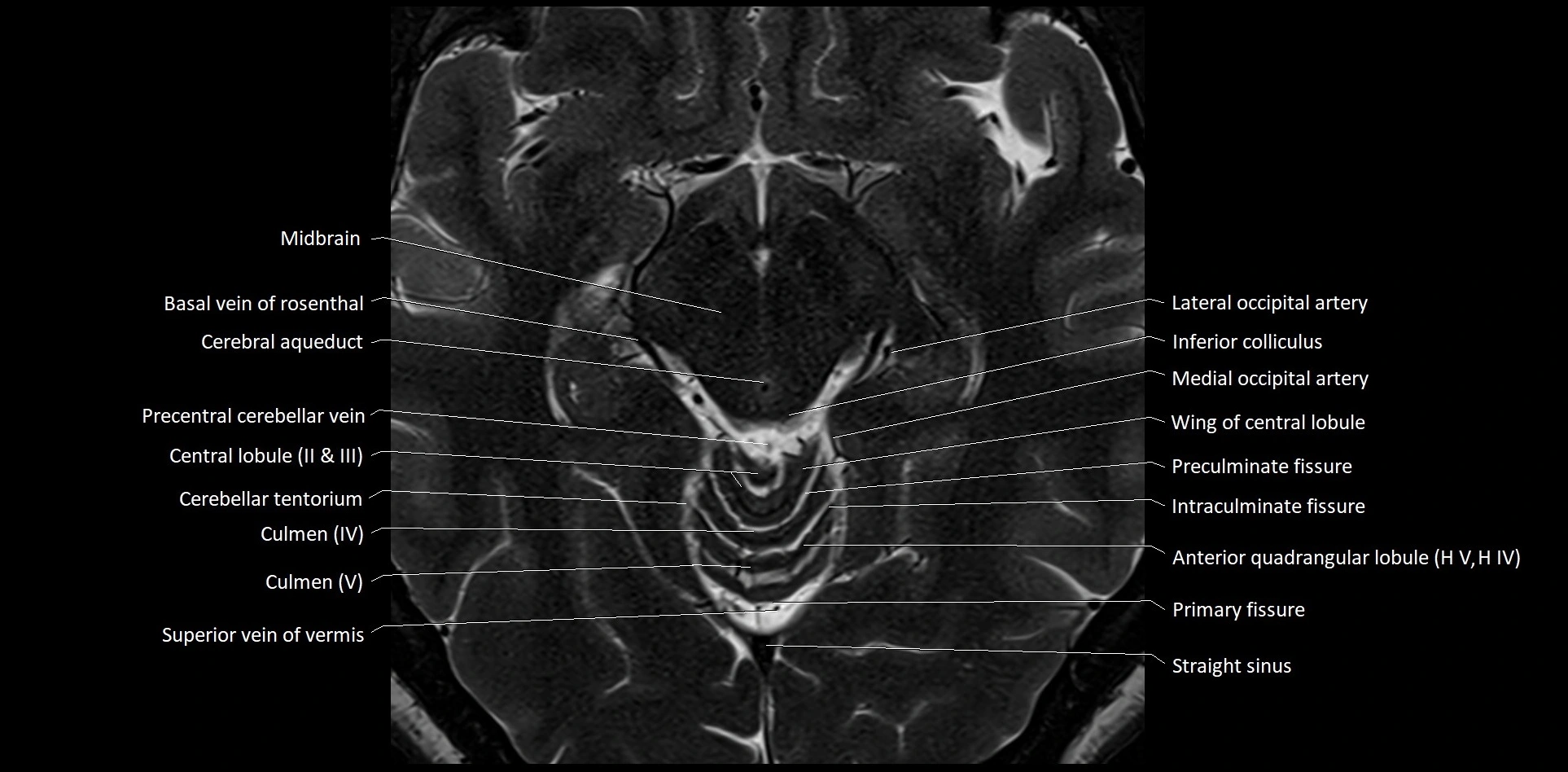 MRI Cerebellar anatomy High-resolution labelled 3T MRI image 26.webp